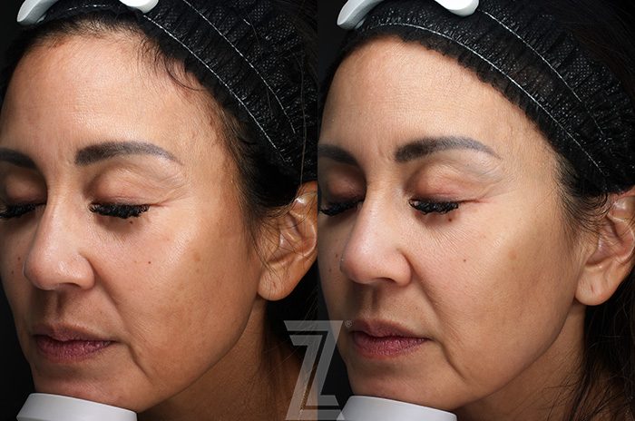 After: Profound® RF Microneedling — Case 11897, The Piazza Center Austin