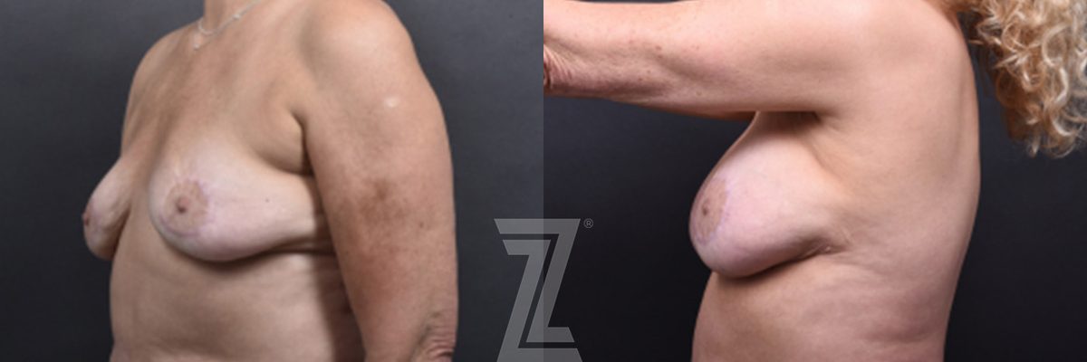 After: Fat Transfer Breast Augmentation — patient case, The Piazza Center Austin