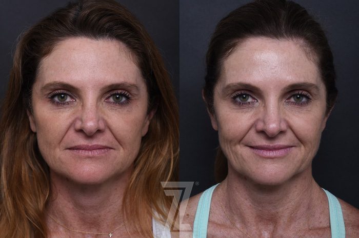 After: ezGEL PRF — patient case, The Piazza Center Austin