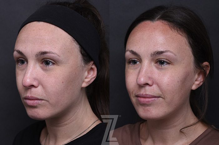 After: Wrinkle Relaxers, Fillers — Case 12216, The Piazza Center Austin