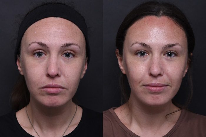 Before: Wrinkle Relaxers, Fillers — Case 12216, The Piazza Center Austin