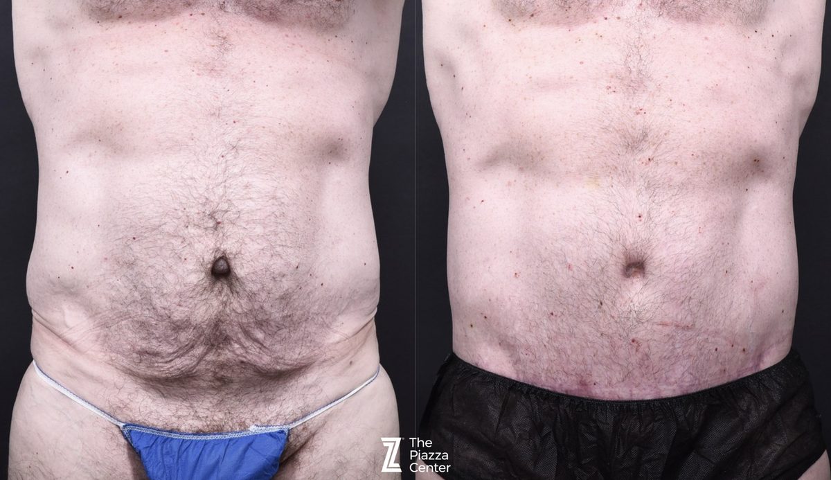 Before: Tummy Tuck, Liposuction, Male Body Contouring — Case 072391, The Piazza Center Austin