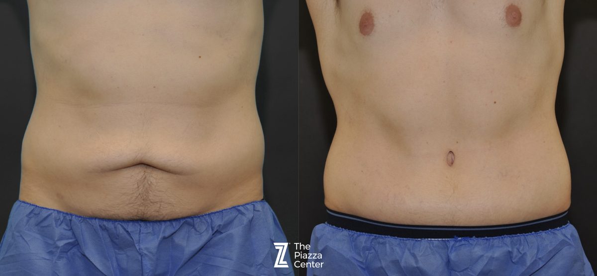 Before: Tummy Tuck, Liposuction, Male Body Contouring — patient case, The Piazza Center Austin