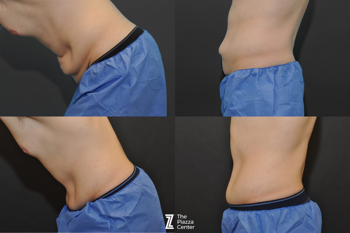 After: Tummy Tuck, Liposuction, Male Body Contouring — patient case, The Piazza Center Austin