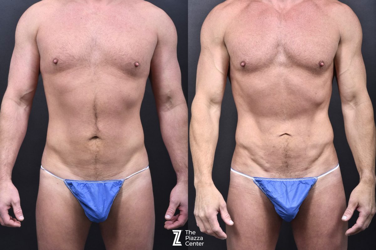 Before: Body Banking, Liposuction, Male Body Contouring — patient case, The Piazza Center Austin