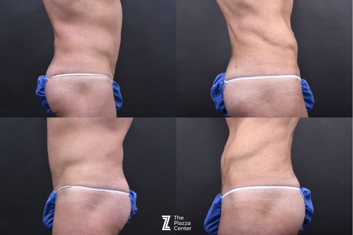 After: Body Banking, Liposuction, Male Body Contouring — patient case, The Piazza Center Austin