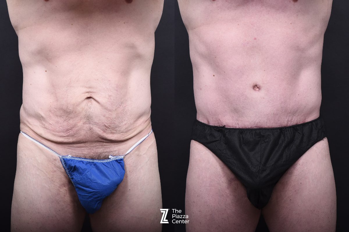 Before: Tummy Tuck, Liposuction, Male Body Contouring — patient case, The Piazza Center Austin