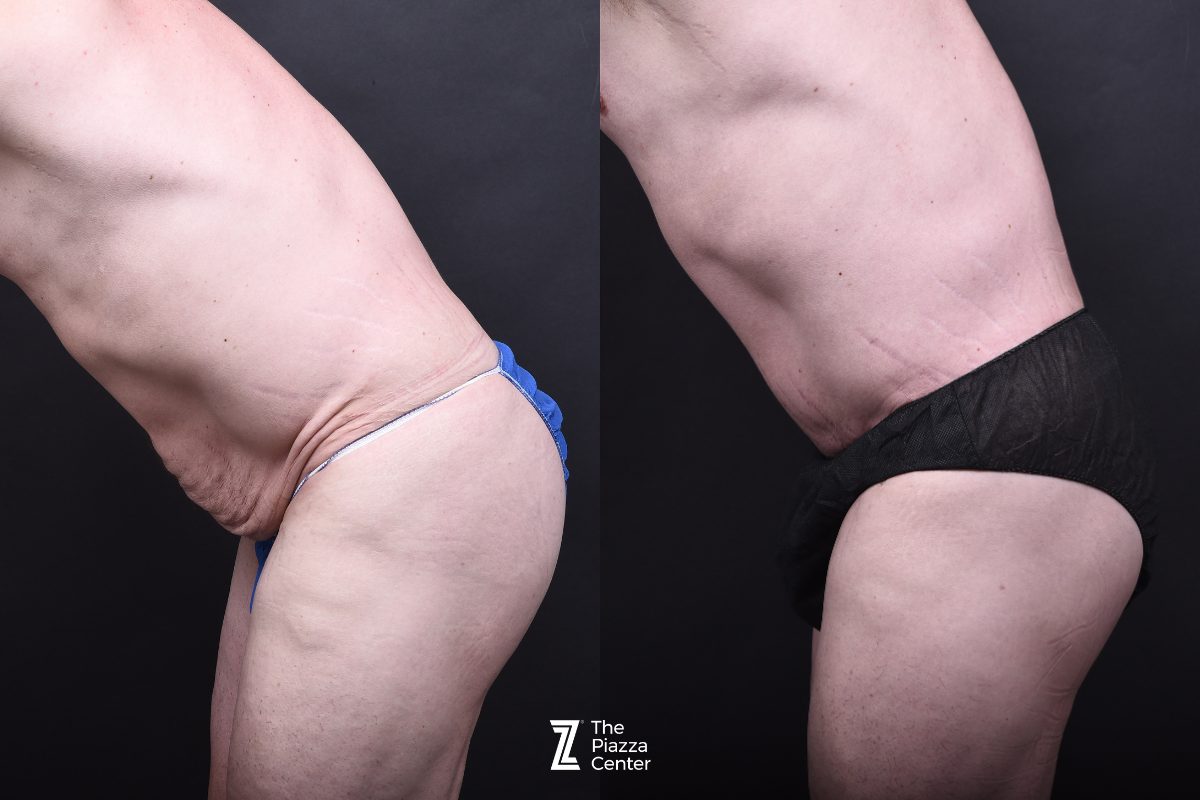 After: Tummy Tuck, Liposuction, Male Body Contouring — patient case, The Piazza Center Austin