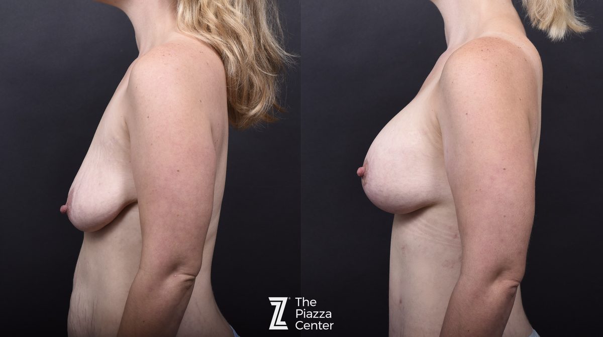 After: Breast Augmentation, Motiva Implants, Breast Augmentation With a Breast Lift — Case 460, The Piazza Center Austin