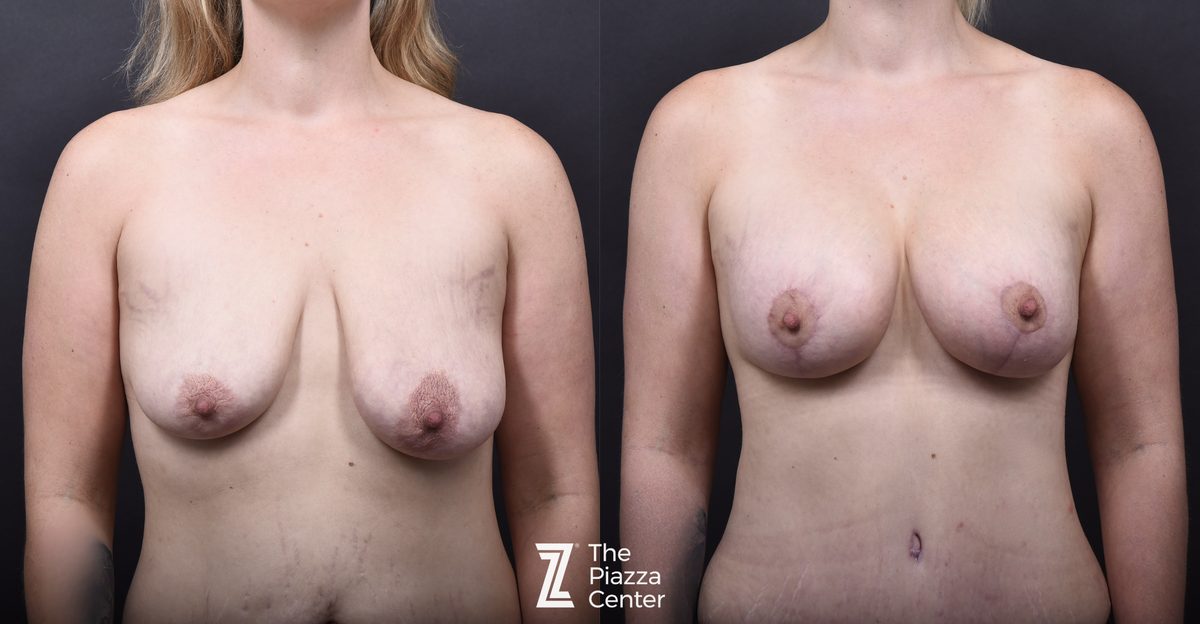 Before: Breast Augmentation, Motiva Implants, Breast Augmentation With a Breast Lift — Case 460, The Piazza Center Austin