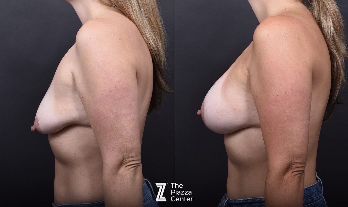 After: Breast Augmentation, Motiva Implants, Breast Augmentation With a Breast Lift — patient case, The Piazza Center Austin