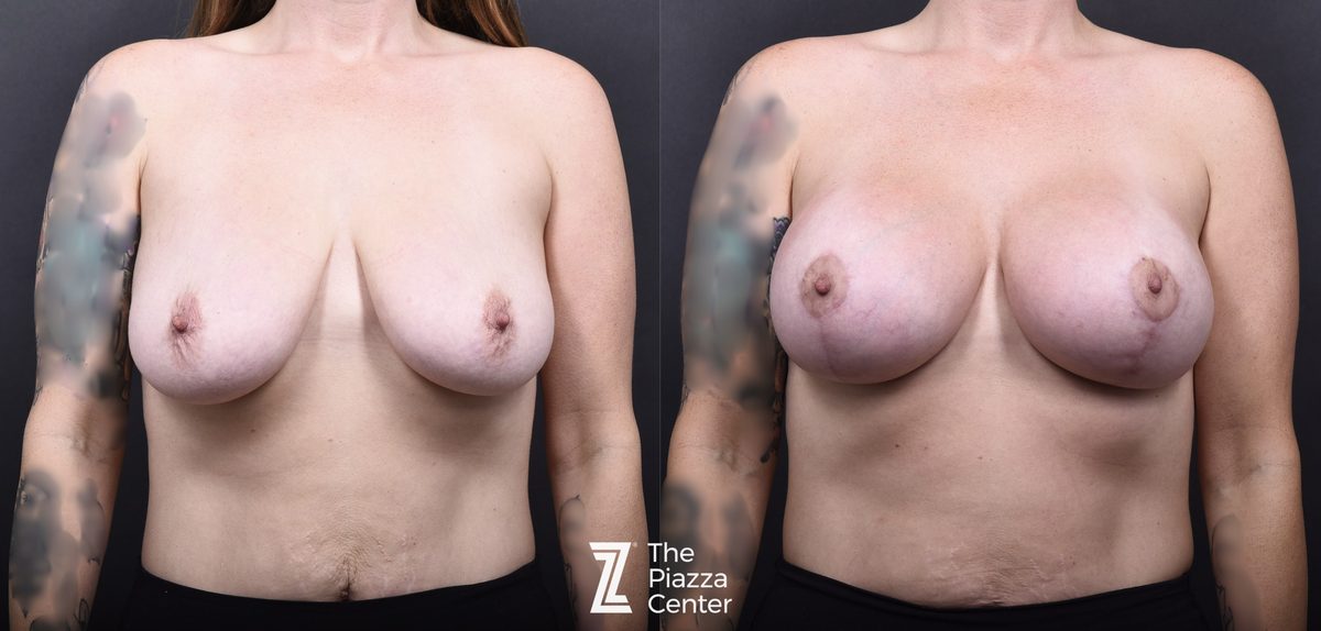 Before: Breast Augmentation, Motiva Implants, Breast Augmentation With a Breast Lift — patient case, The Piazza Center Austin