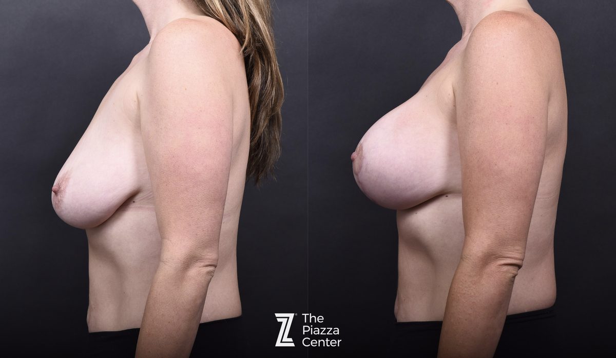 After: Breast Augmentation, Motiva Implants, Breast Augmentation With a Breast Lift — patient case, The Piazza Center Austin