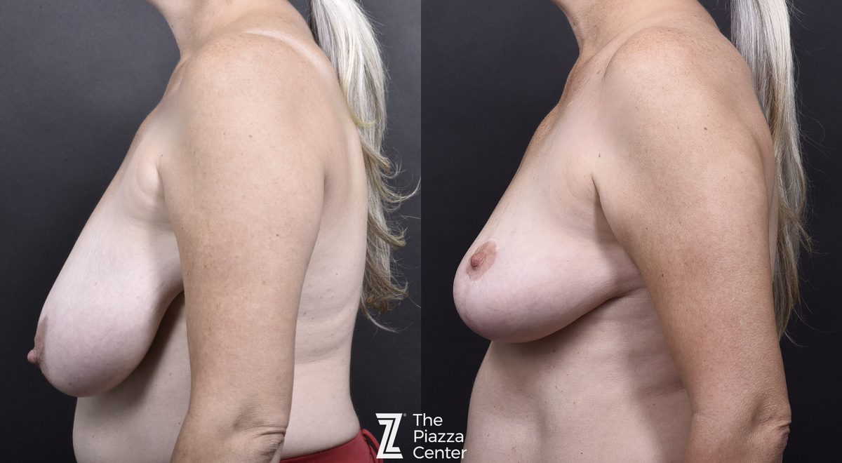 After: Breast Reduction, Breast Lift — Case 481, The Piazza Center Austin