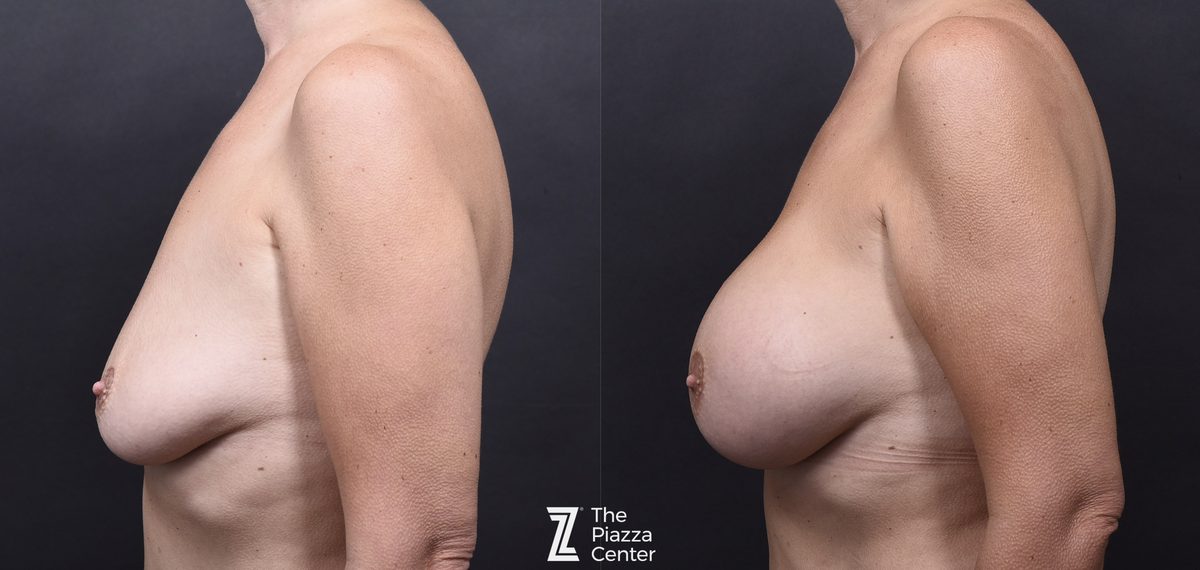 After: Breast Augmentation — patient case, The Piazza Center Austin