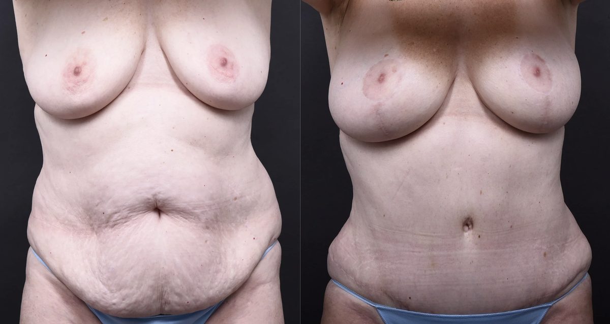 Before: Breast Augmentation with Lift, Tummy Tuck, Mommy Makeover — patient case, The Piazza Center Austin