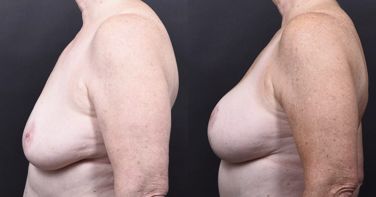 After: Breast Augmentation with Lift, Tummy Tuck, Mommy Makeover — patient case, The Piazza Center Austin