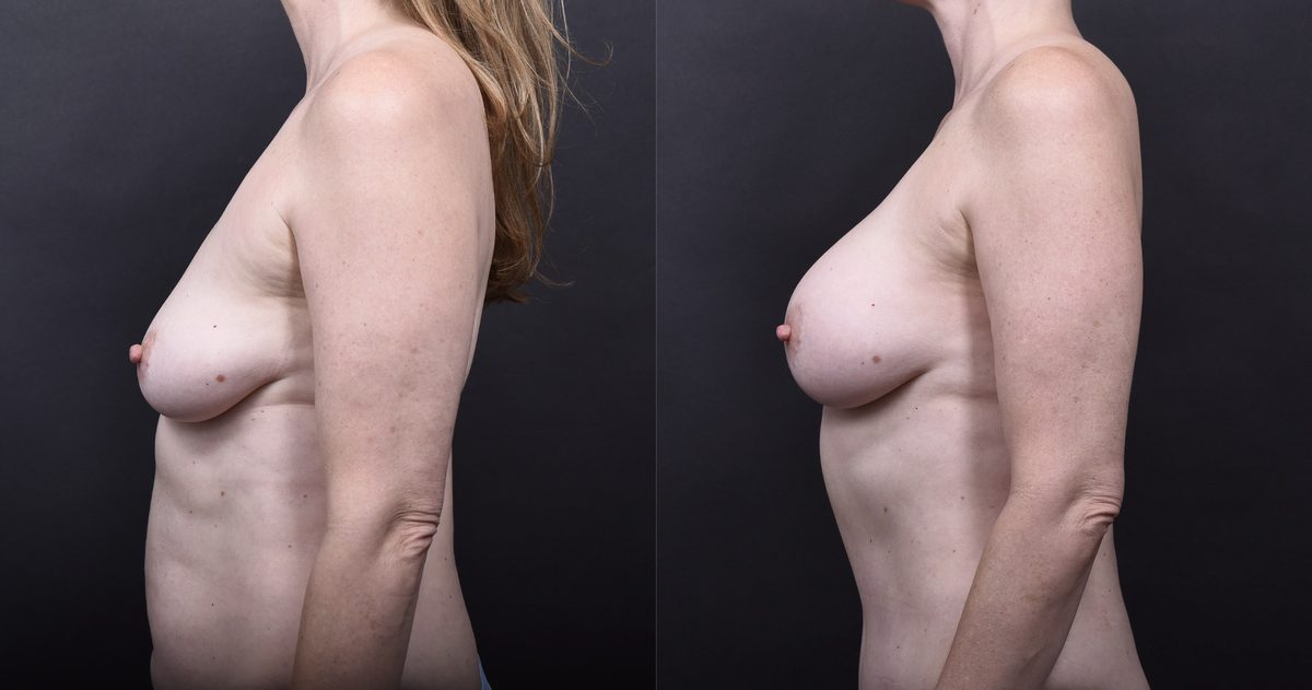 After: Breast Augmentation, Breast Augmentation Fat Transfer, Tummy Tuck, Mommy Makeover — patient case, The Piazza Center Austin