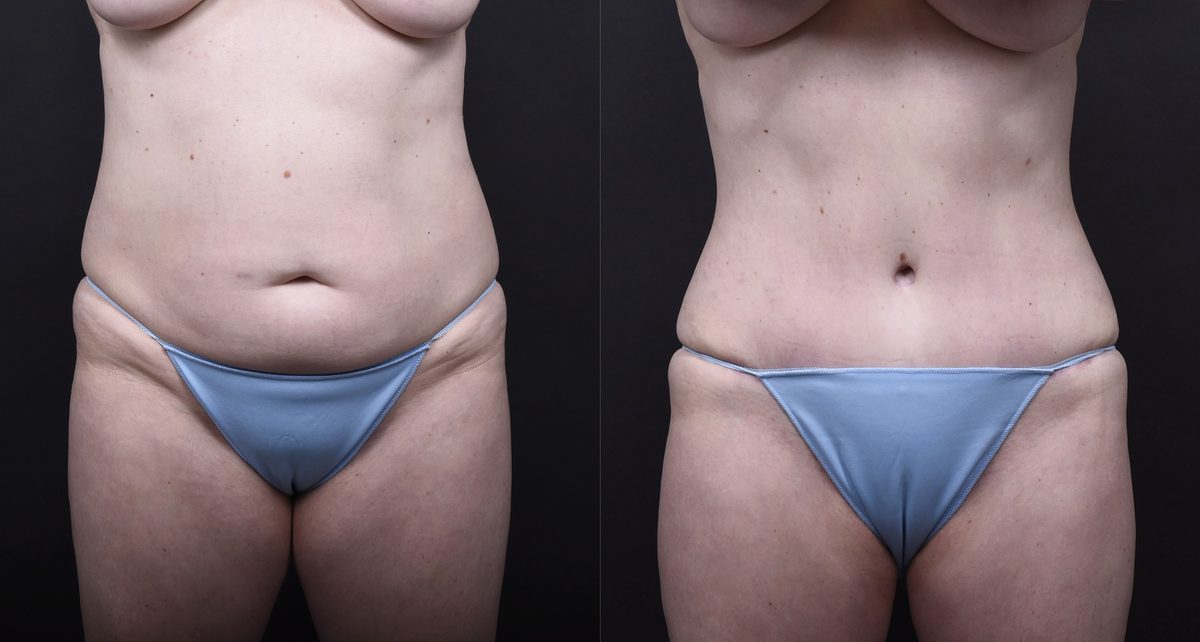 Before: Breast Augmentation, Breast Augmentation Fat Transfer, Tummy Tuck, Mommy Makeover — patient case, The Piazza Center Austin