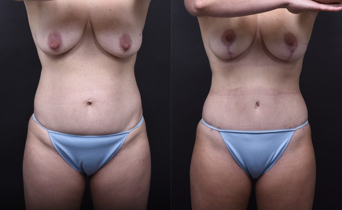 Before: Breast Reduction, Breast Lift, Tummy Tuck, Mommy Makeover — patient case, The Piazza Center Austin