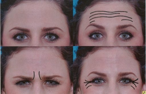 Forehead treatment mapping showing dynamic wrinkle patterns targeted by BOTOX