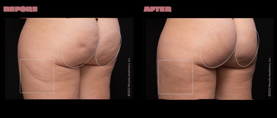Avéli cellulite treatment before and after results at 3 months