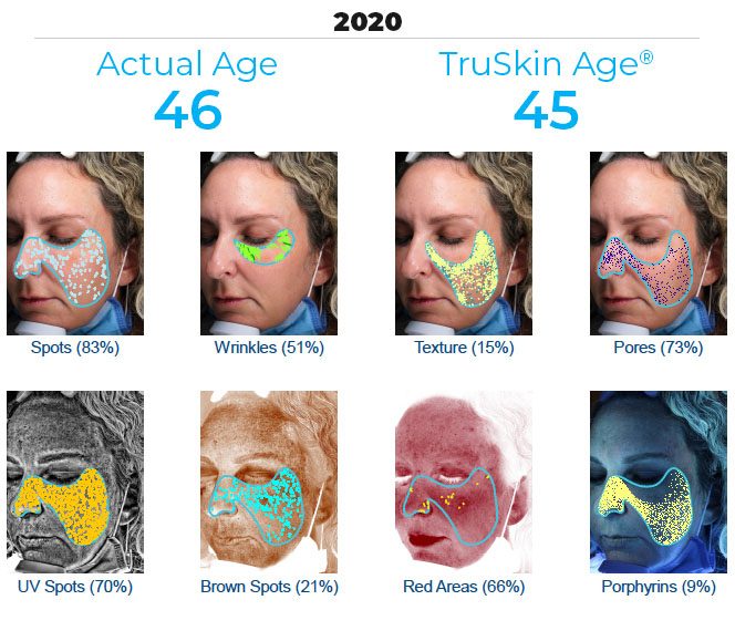 Sample Visia skin analysis report showing spots, wrinkles, texture, and pore scoring