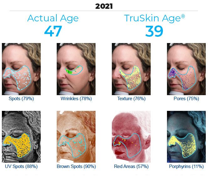 Sample Visia skin analysis report comparing actual age to TruSkin Age results