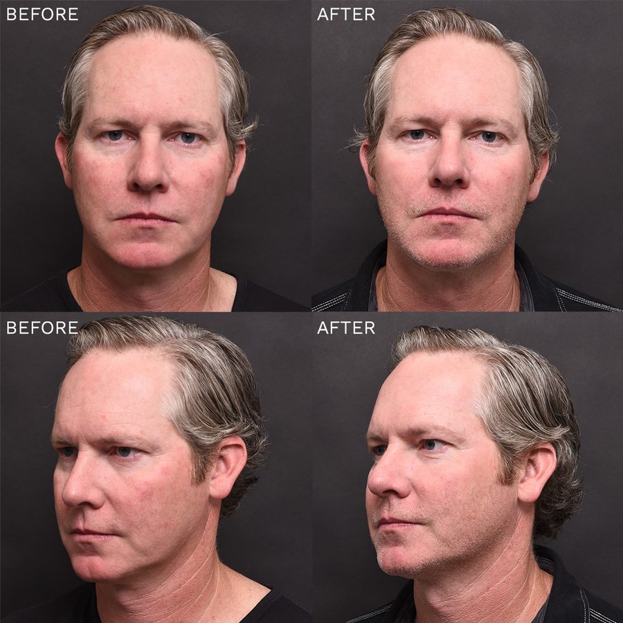 Before and after HALO laser treatment results showing improved skin texture and tone