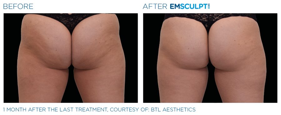 Before and after photos of a female patient's buttock area one month after Emsculpt NEO treatment