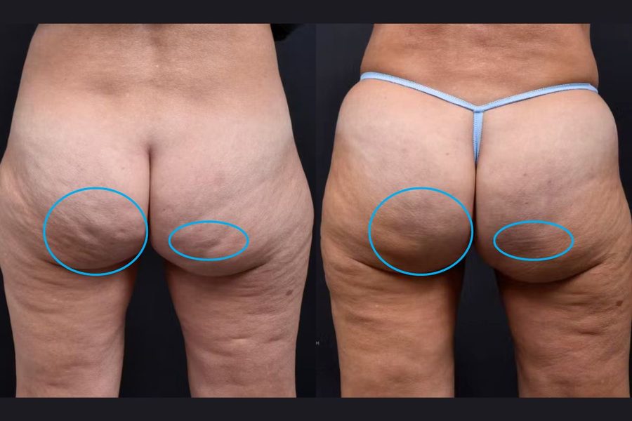 Before and after Avéli cellulite treatment showing smoother buttocks and thigh skin