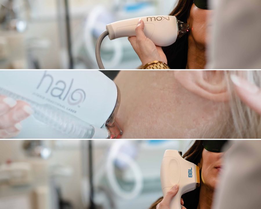 HALO hybrid fractional laser handpiece used during an in-office treatment at The Piazza Center