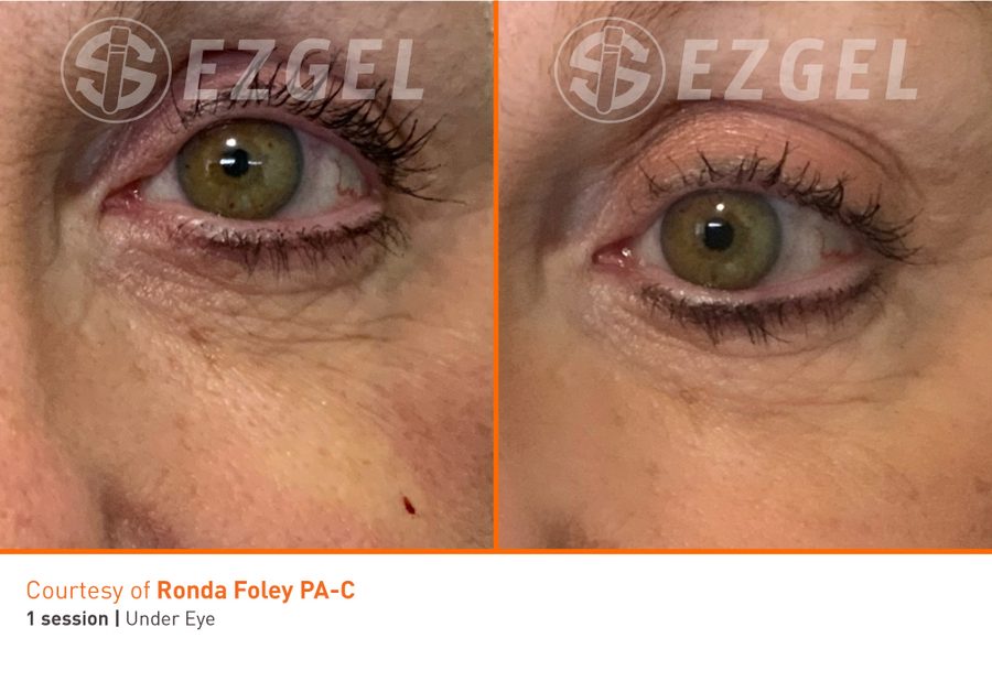ezGEL Before and After Eye under eye results from ezGEL