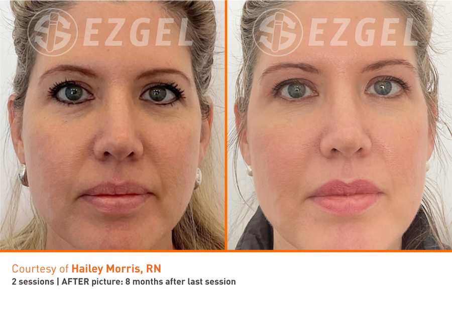 ezGEL Before and After ezGEL Results