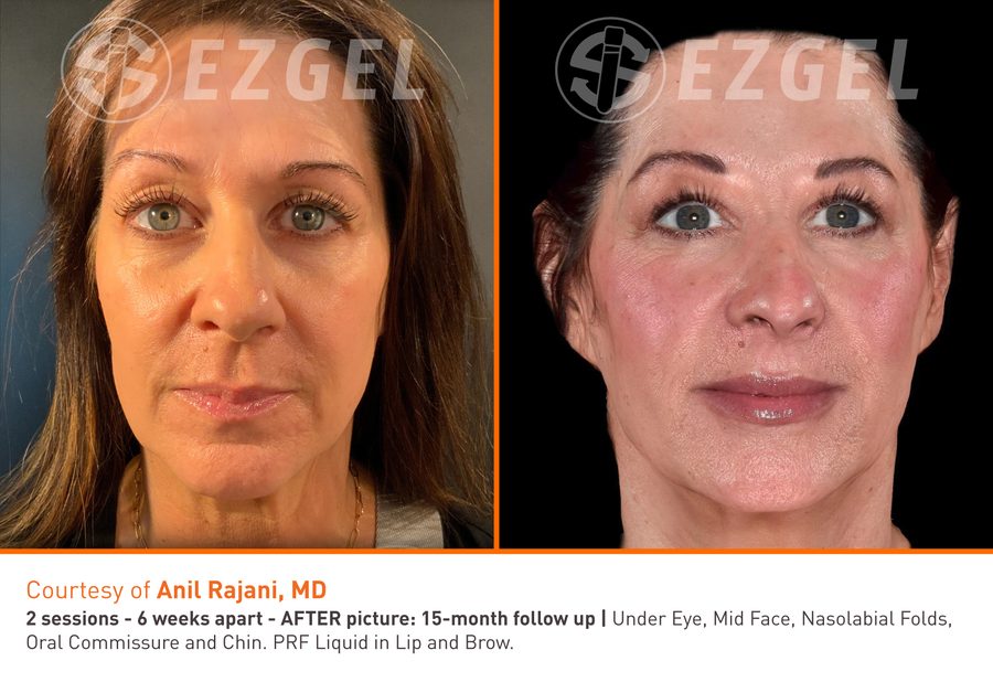 ezGEL Before and After 3 before and after results from ezGEL
