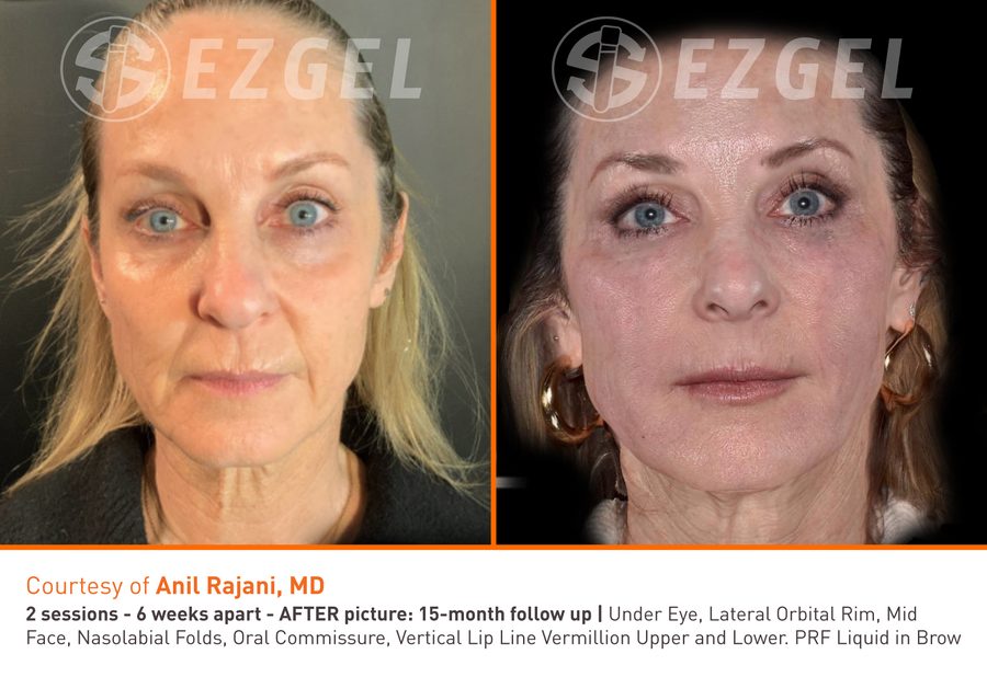 ezGEL before and after results showing improvement to under-eye hollows and midface, courtesy of Anil Rajani, MD