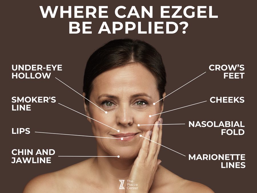 Diagram showing where ezGEL can be applied: under-eye hollows, crow's feet, cheeks, nasolabial folds, lips, marionette lines, chin and jawline