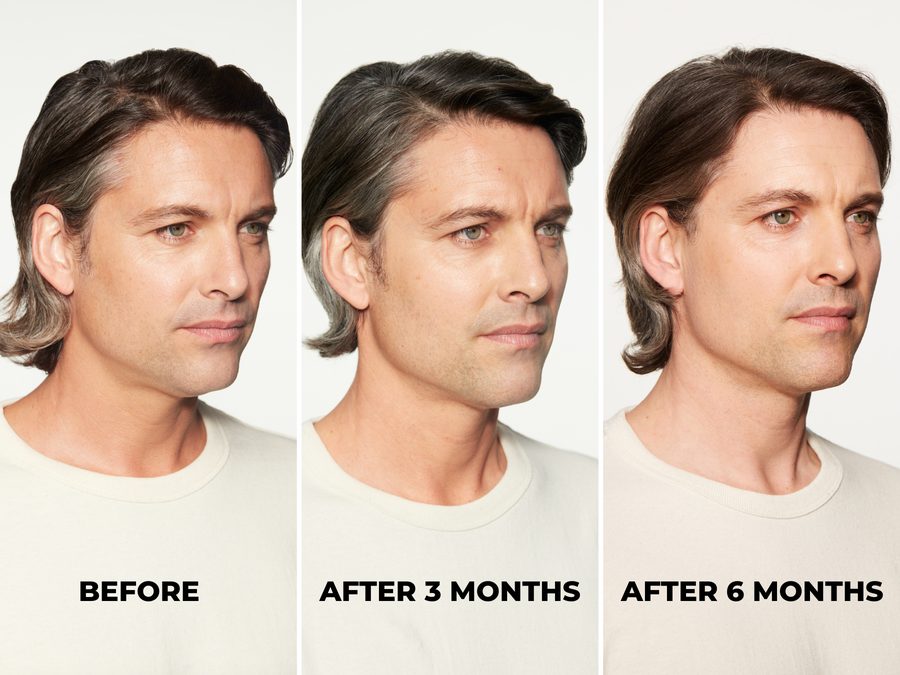 Sculptra results progression shown before treatment, after 3 months, and after 6 months