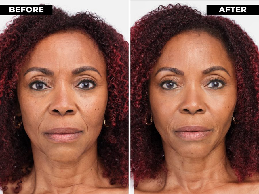 Radiesse results shown before and after treatment