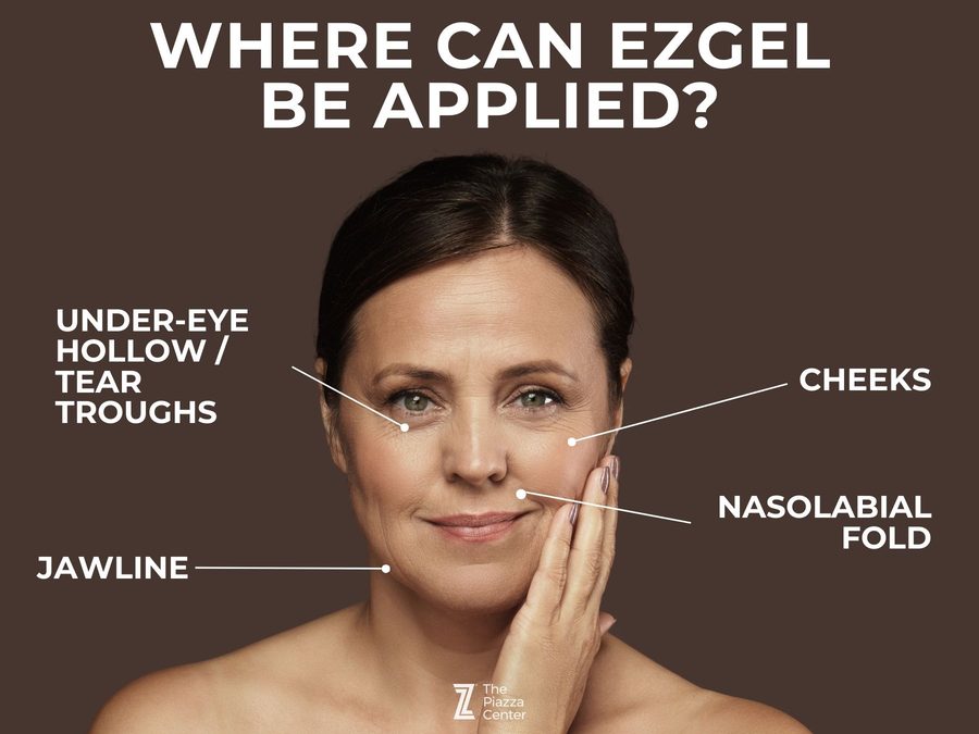 Diagram showing ezGEL PRF treatment areas: under-eye hollows, cheeks, nasolabial fold, and jawline