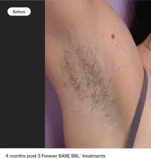 Before laser hair removal treatment, underarm hair visible