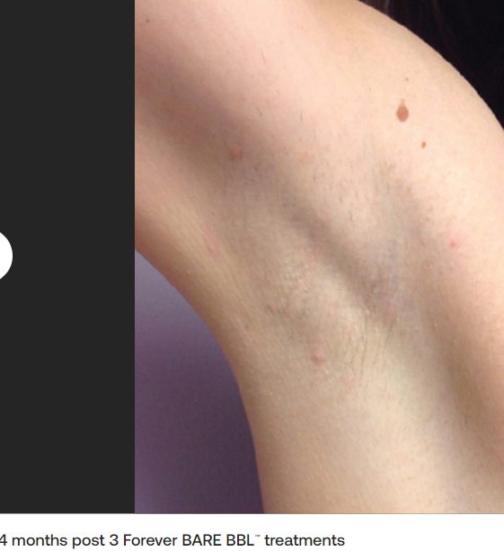 After 4 months and 3 Forever Bare BBL laser hair removal treatments, smooth underarm skin