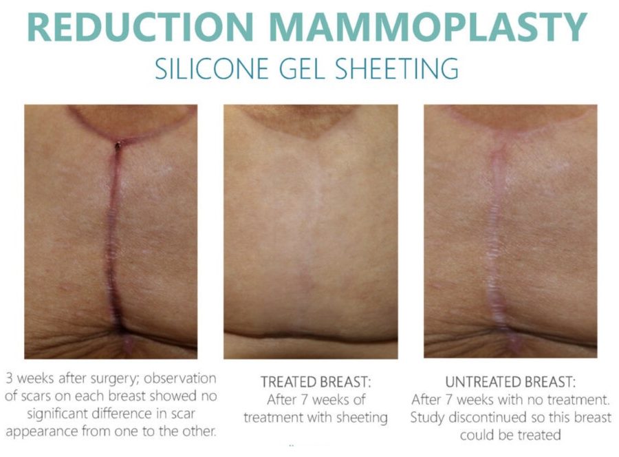 Breast Aug Scar Healing