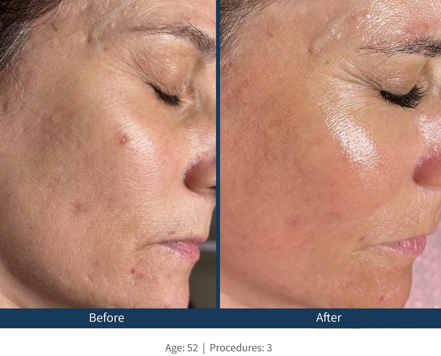 Texture + Pore Size after Microneedling Austin TX