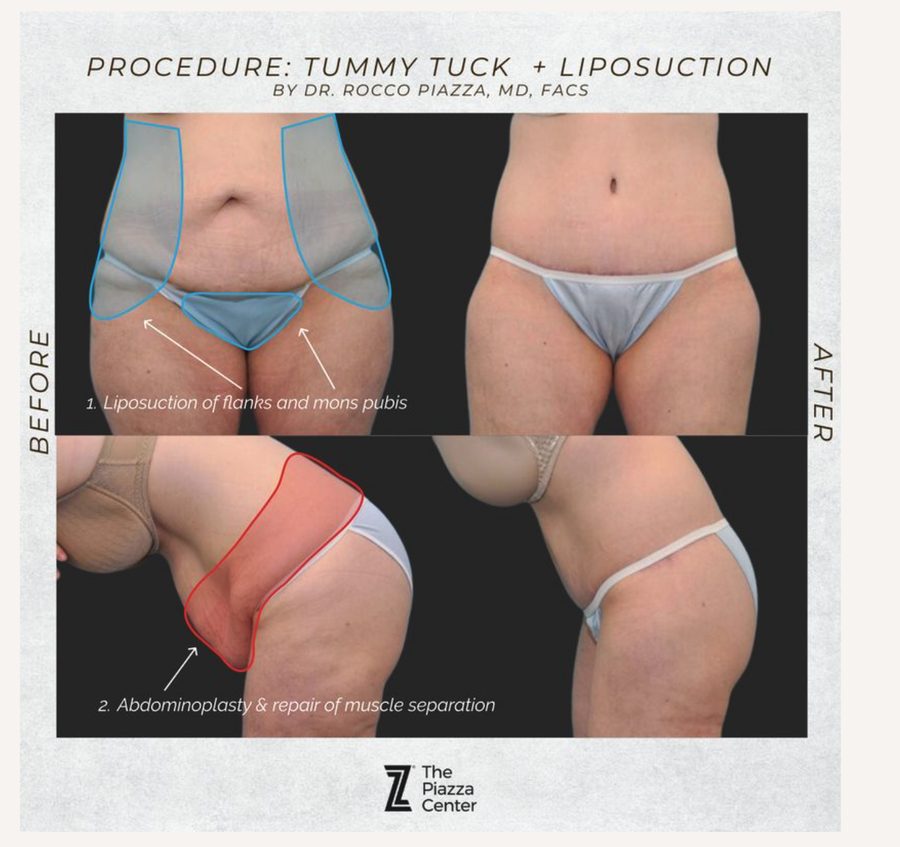 Tummy tuck area of focus infographic