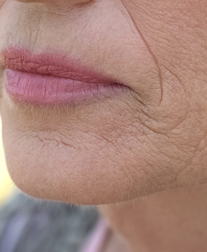 Close-up of deep lines around the mouth before Contour TRL treatment