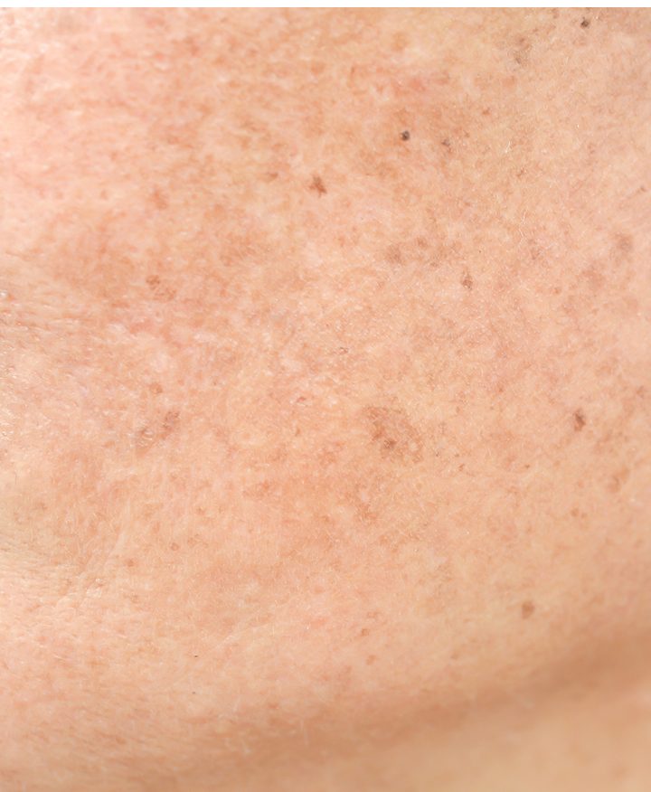 Close-up of uneven skin tone before Contour TRL treatment