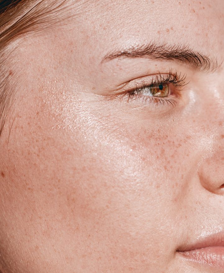 Close-up of sun damage and freckling before Contour TRL treatment