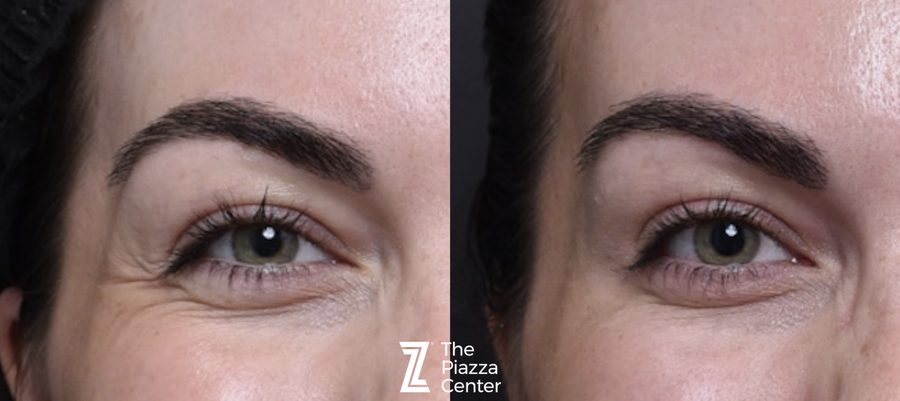 Before and after crow's feet treatment with Dysport at The Piazza Center