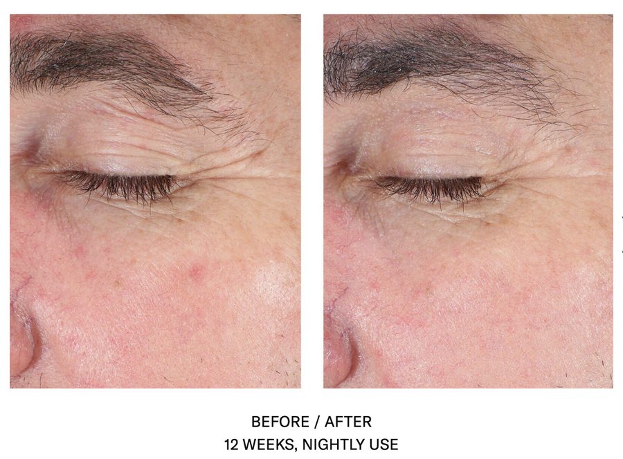 EyeMax AlphaRet Overnight Cream Results Crows Feet Crows Feet treatment with SkinBetter Eye Cream